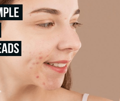 acne pimple popping blackheads