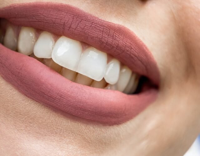 Lip Fillers Before and After